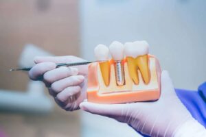 dental implants vs bridges