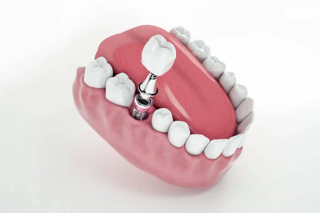 how to care for your dental implants and dentures for long lasting results