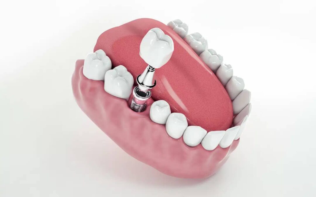 how to care for your dental implants and dentures for long lasting results