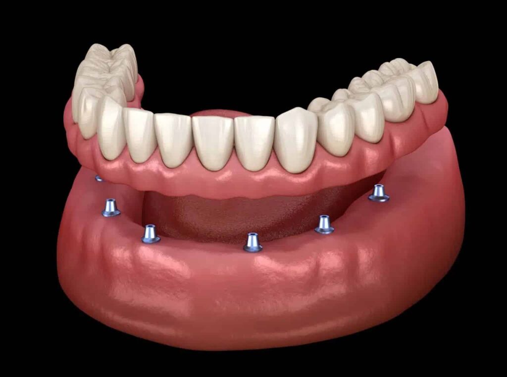 the advantages of implant supported dentures over traditional dentures