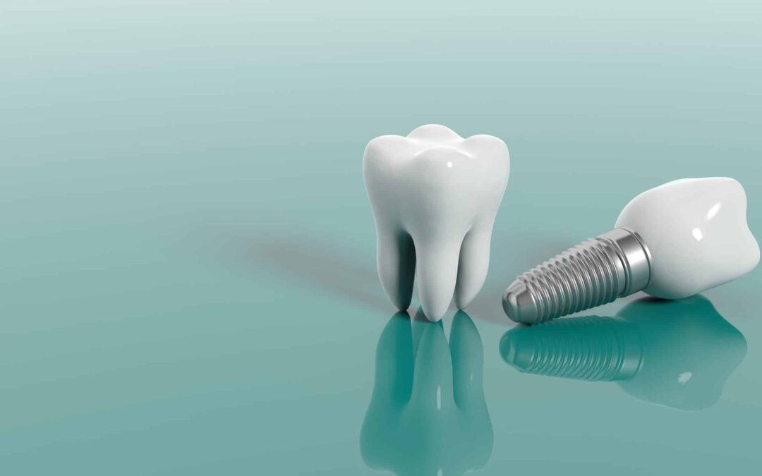 Frequently Asked Questions About Dentures and Implants: Answers from a Dental Expert