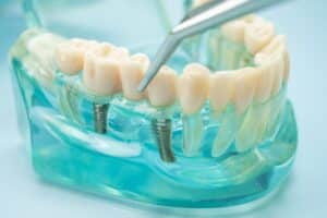 Cost of Full Mouth Dental Implants in Atlanta, GA