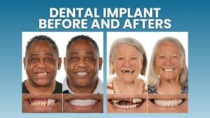 Dental Implants Before and After Transformations