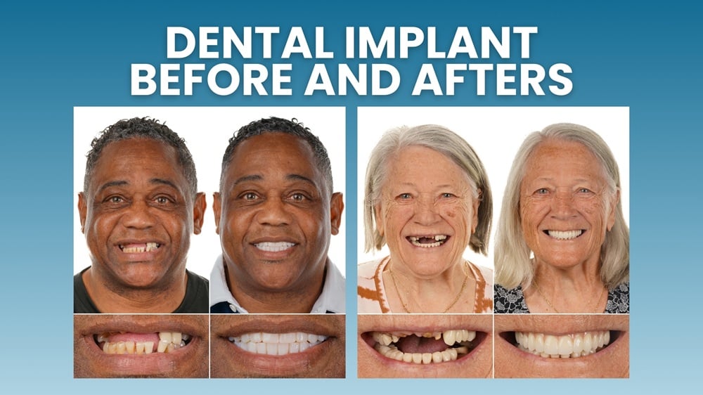 Dental Implants Before and After Transformations